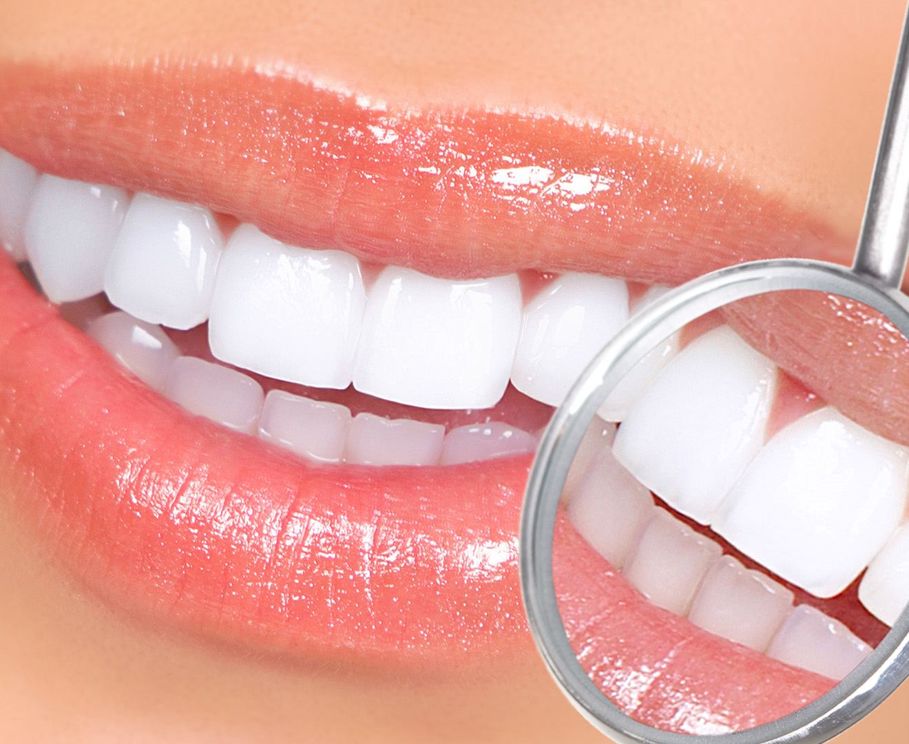 teeth whitening impression kit