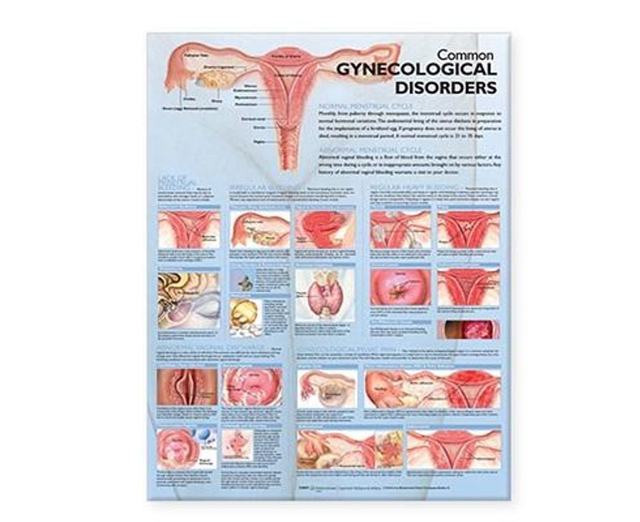 Common Gynecological Disorders Anatomical Chart Paper Unmounted |  Www.catch.com.au