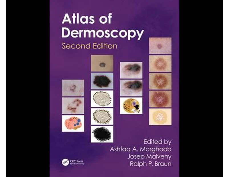 An Atlas of Dermoscopy : 2nd Edition