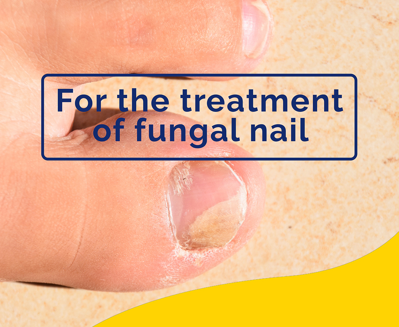What Fungal Nail Treatments Are There? | Doubleview Podiatry