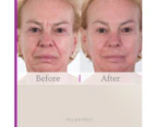 My Perfect Facial 5 Treatments