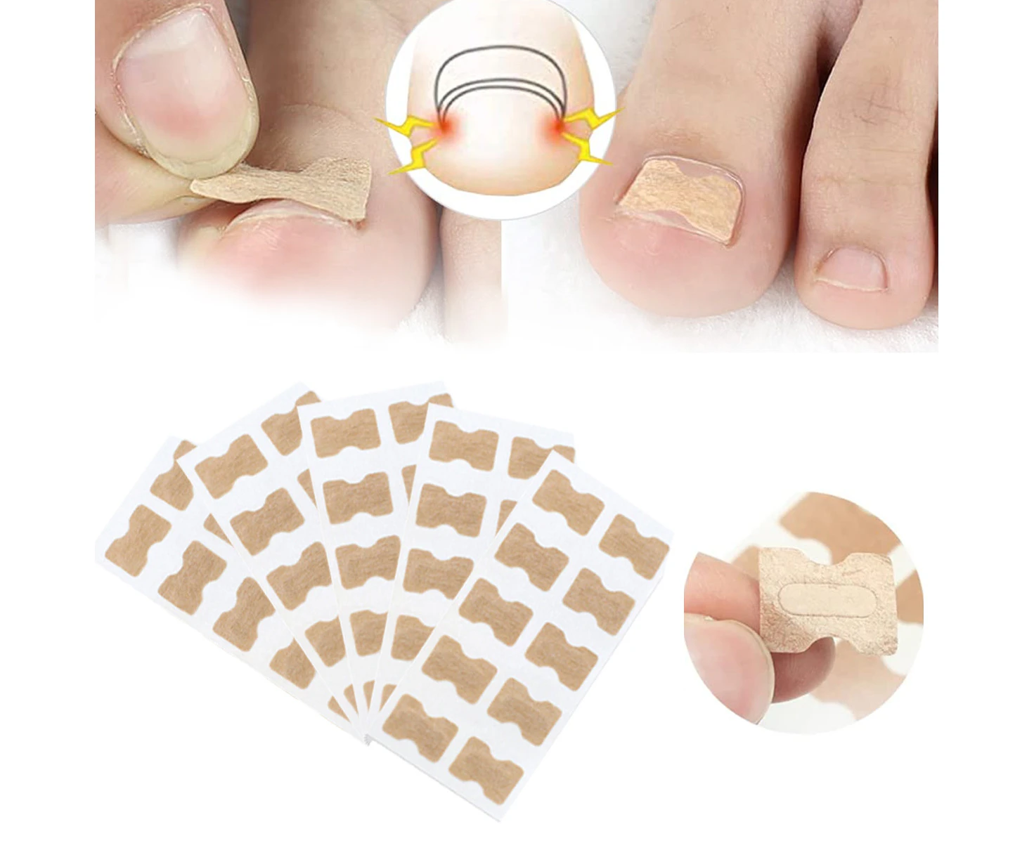 Ingrown Toenail Correction Stickers, Painless Pedicure Toenail Corrector Patch Toenail Treatment Tool Foot Care