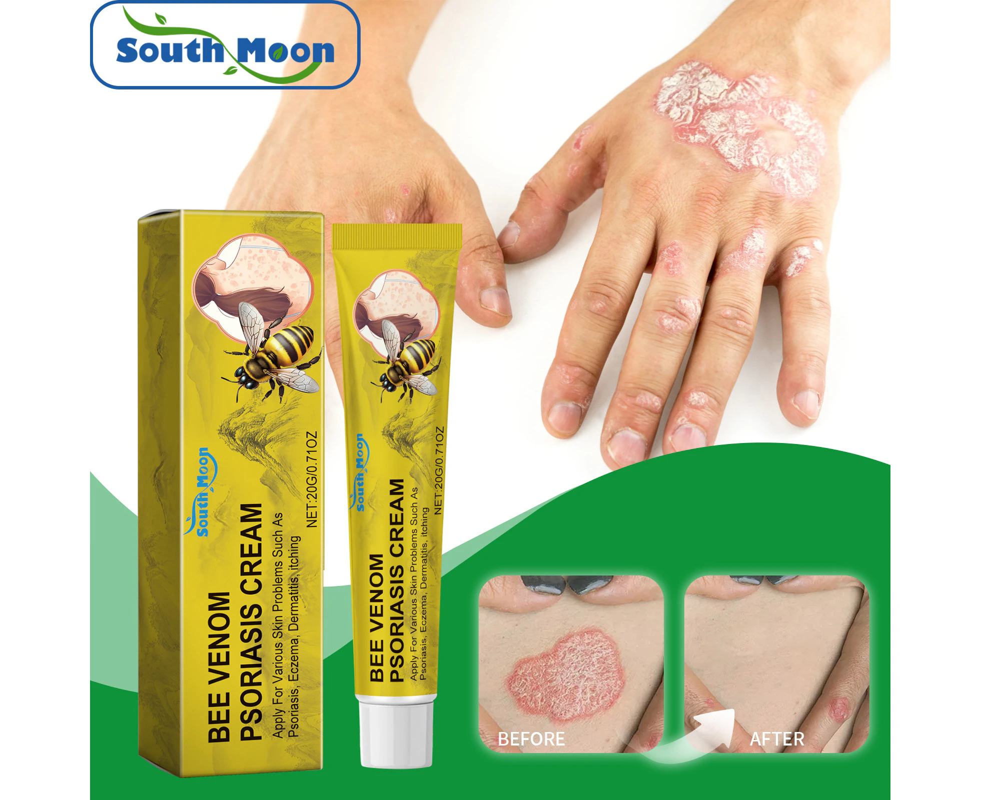 Bee Venom Psoriasis Care Gel  Safe And Gentle Formula For All Skin Types Skin Repair Cream Relieves Skin Itch Repairs Hand And Foot Moss