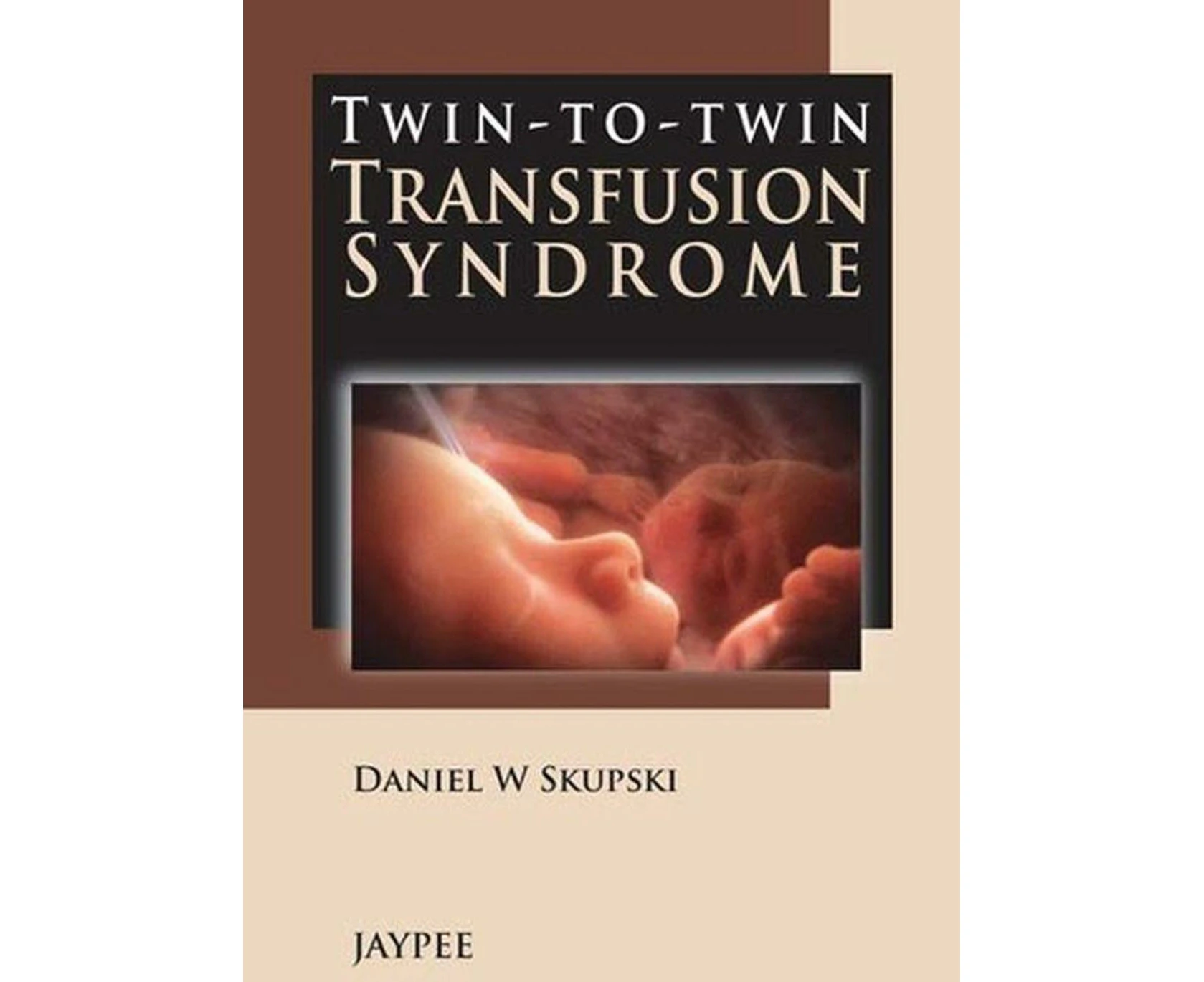 Twin-to-Twin Transfusion Syndrome