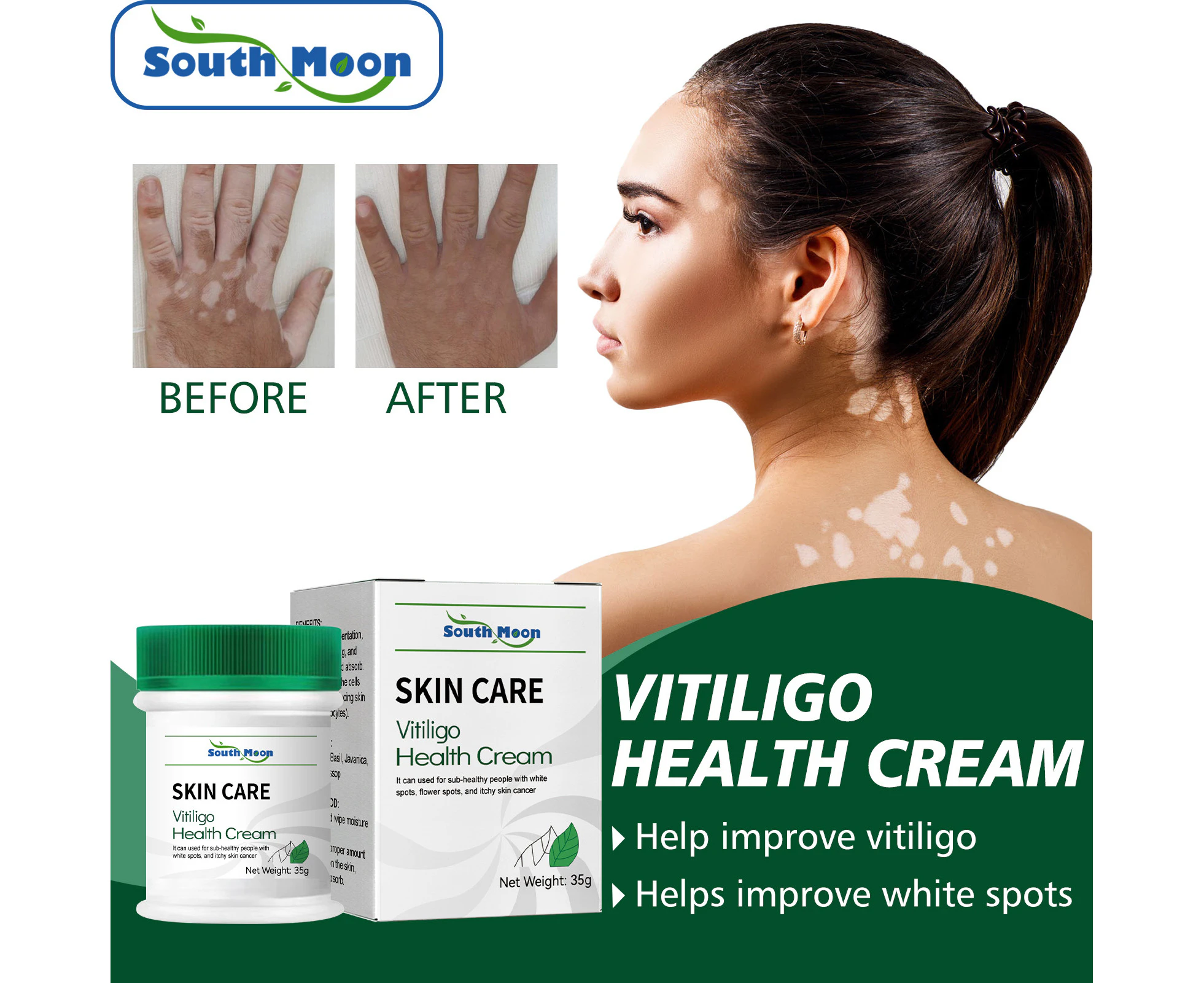 Crema De Vitiligo Para Restaurar La Melanina, 35 G, Crema Antivitiligo Que Reduce Las Manchas Blancas Para Todo Tipo De Piel