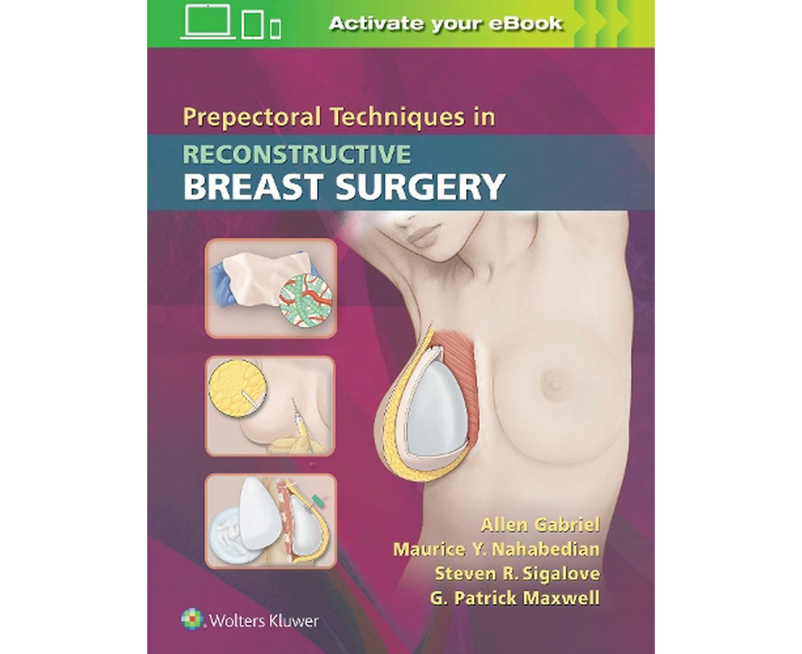 Prepectoral Techniques in Reconstructive Breast Surgery