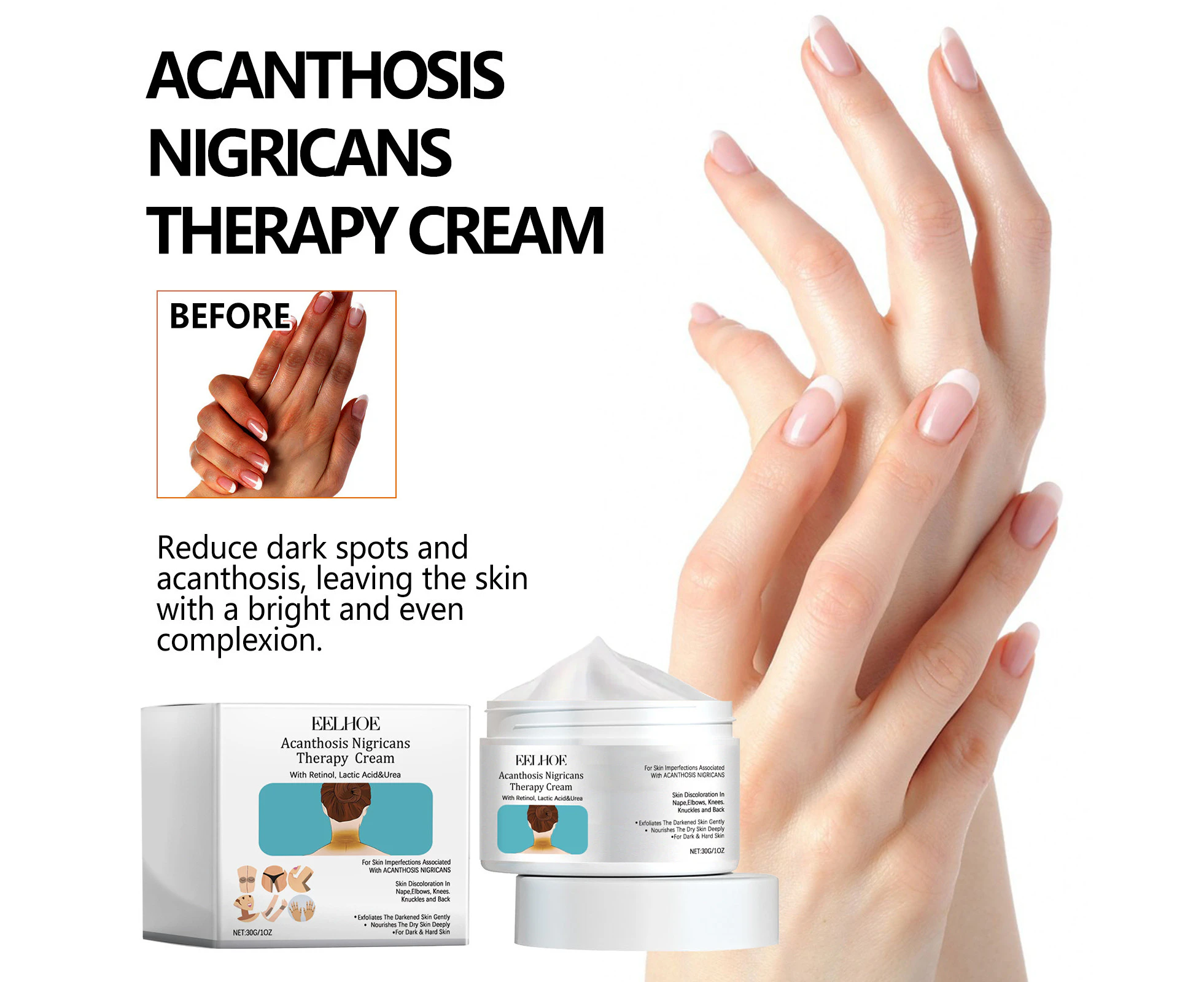 Acanthosis Nigricans Therapy Cream