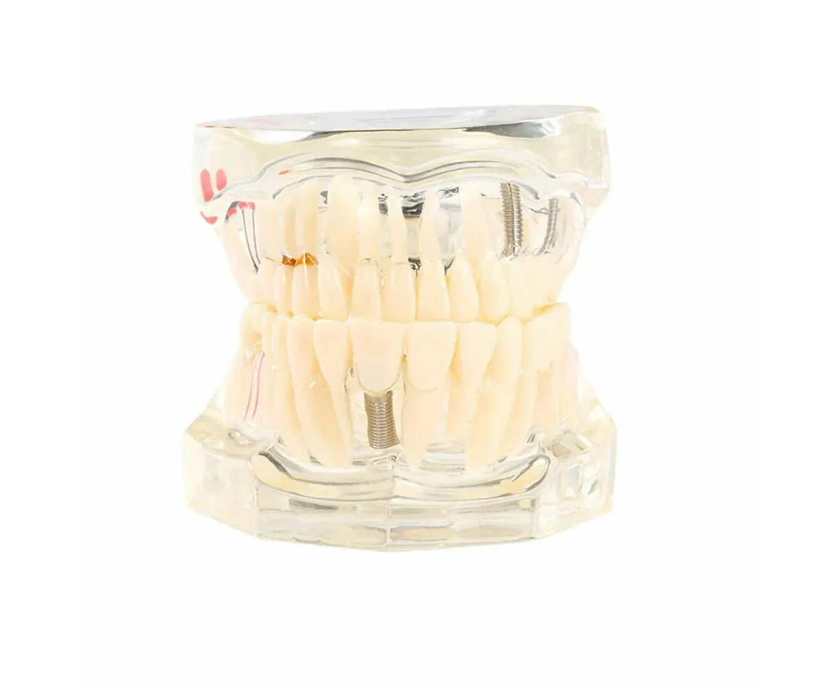 Removable Restorable Dental Models For Teaching Researching Diseases