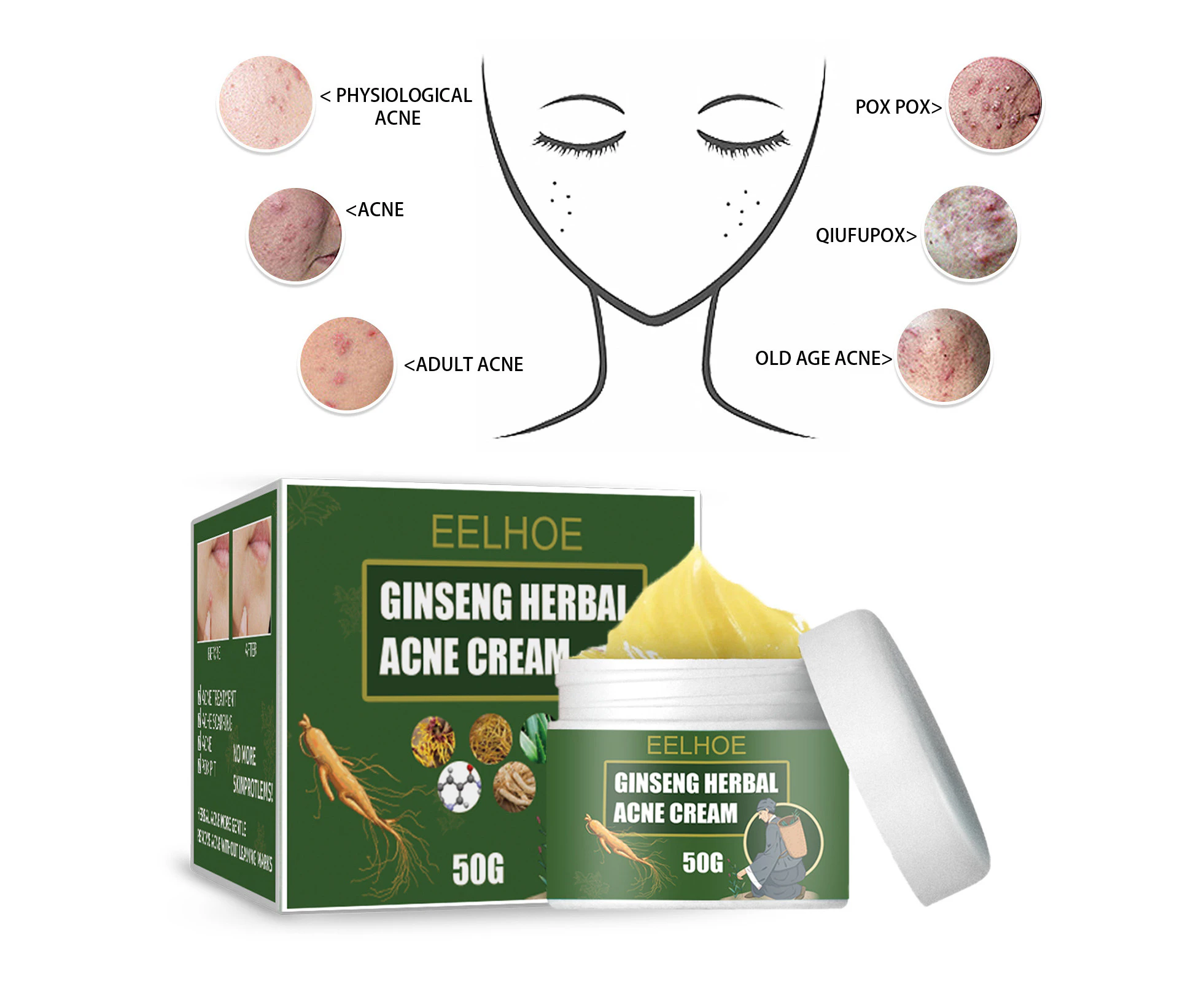 Herbal Acne Cream, Acne Removal, Acne Scar Reduction, Moisturizing, Hydrating, Cleansing Cream, Water-Oil Balancing Acne Cream