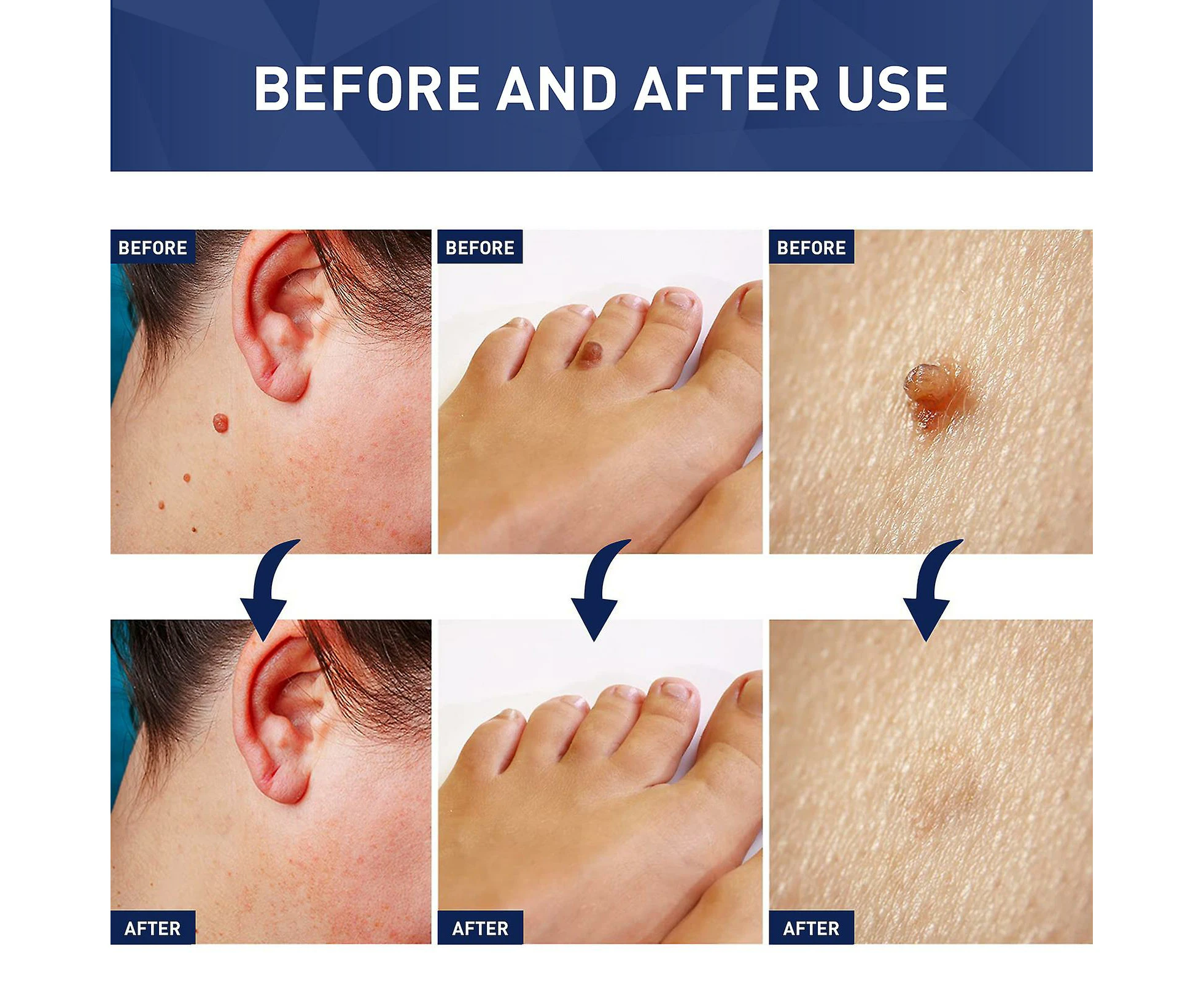 Skin Tag Removal,Natural Wart Remover,Skin Tag Remover Liquid,Safe & Effective,Easy to use,Mild to The Skin